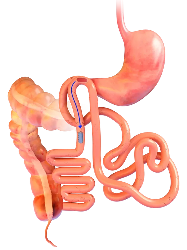 Illustration of the magnets, still joined together, moving on through the intestine after the new path has formed